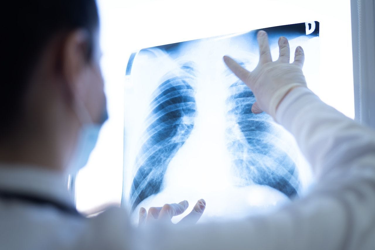 Lung imaging | Image credit: as-artmedia - stock.adobe.com