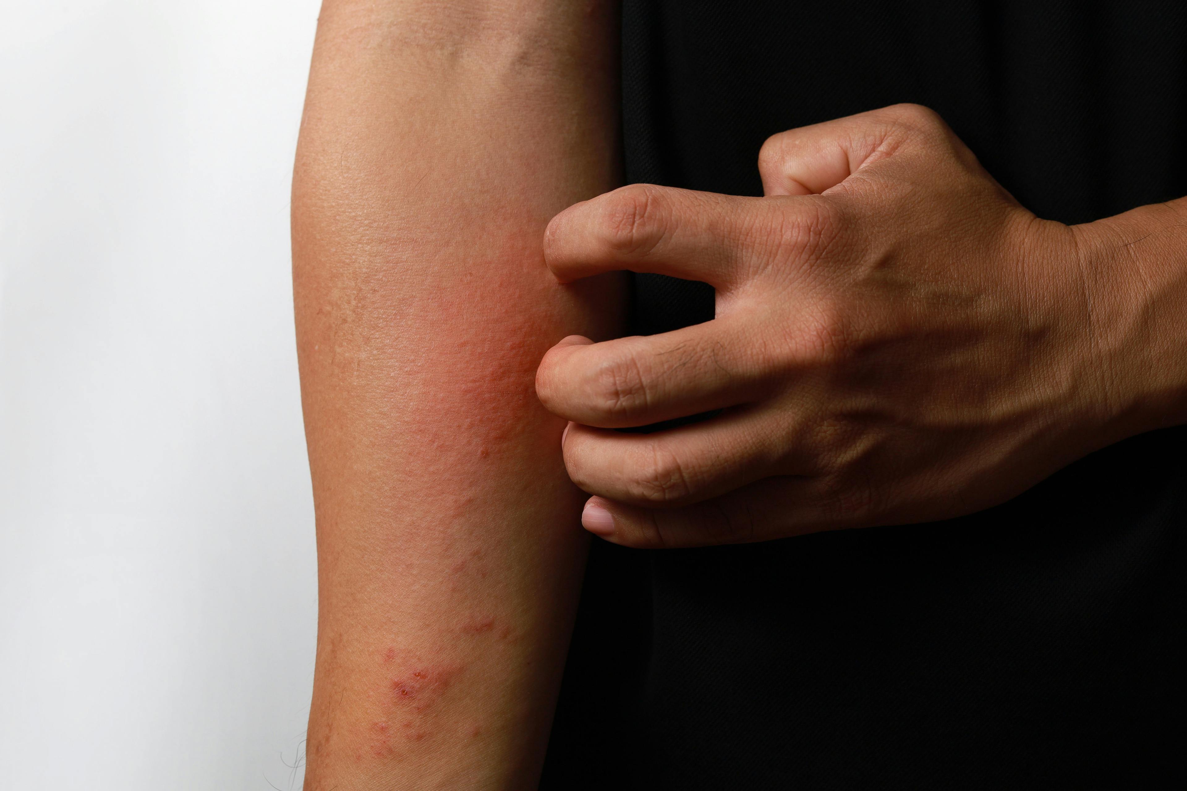Adult scratching atopic dermatitis on arm | Image Credit: ltyuan - stock.adobe.com