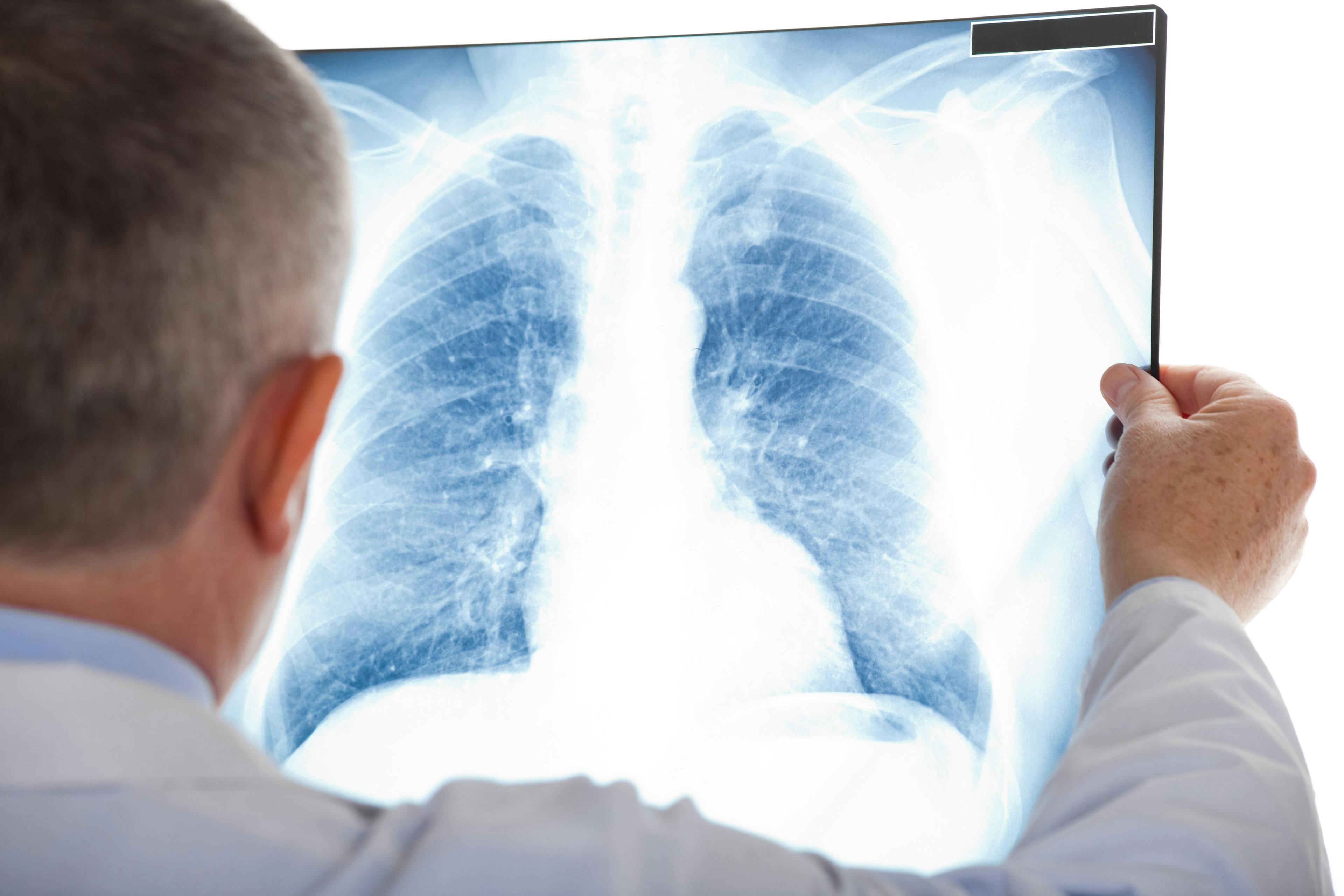 doctor examining a lung x ray