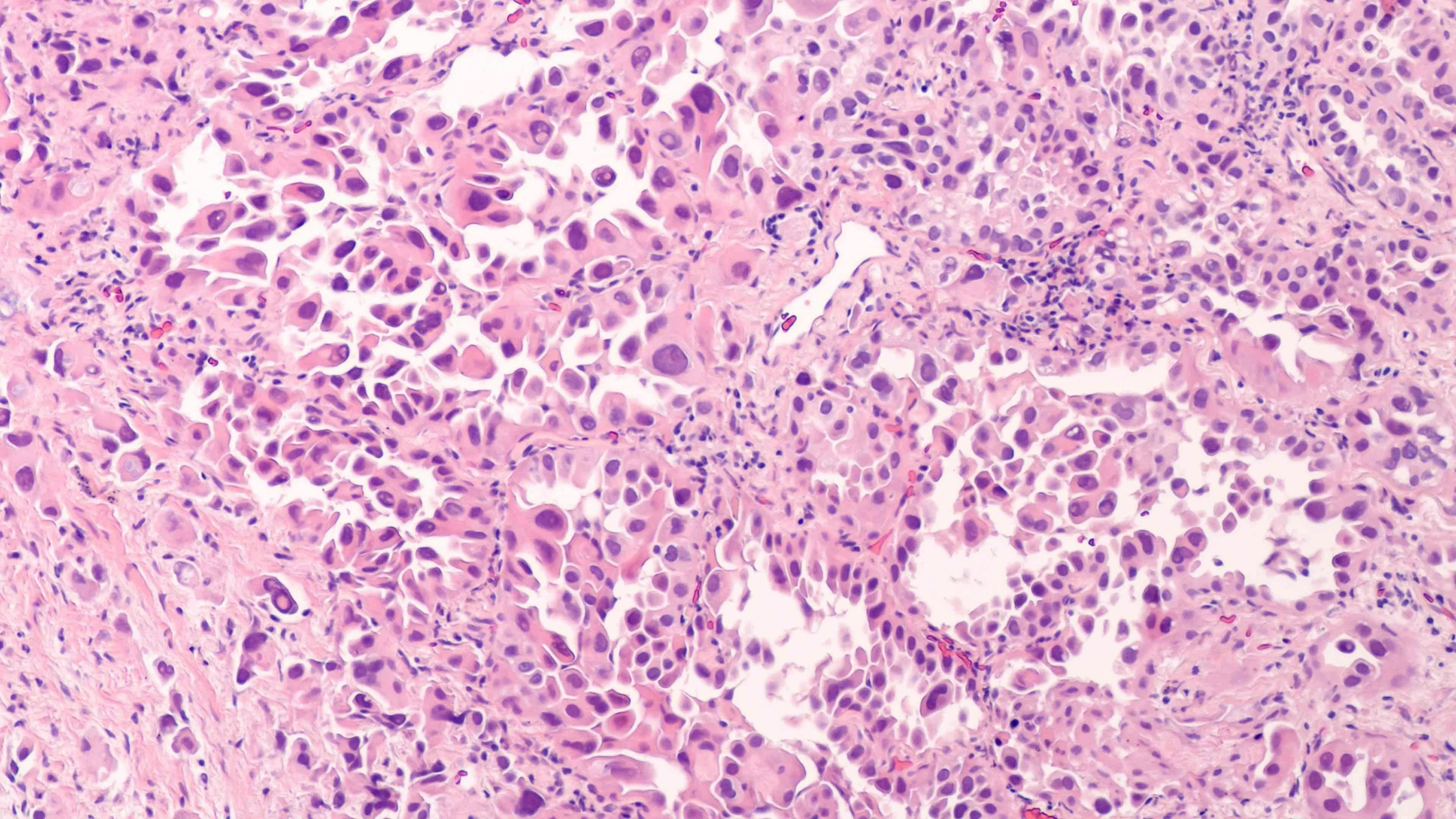 Lung cancer cells | Image credit: David A Litman - stock.adobe.com
