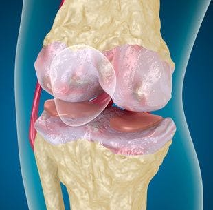 EULAR Recommendations for Abnormalities in Knee Osteoarthritis Need an Update