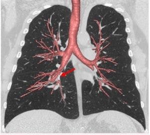 Researchers Make COPD Genetic Discovery That Could Identify At-Risk Patients Earlier