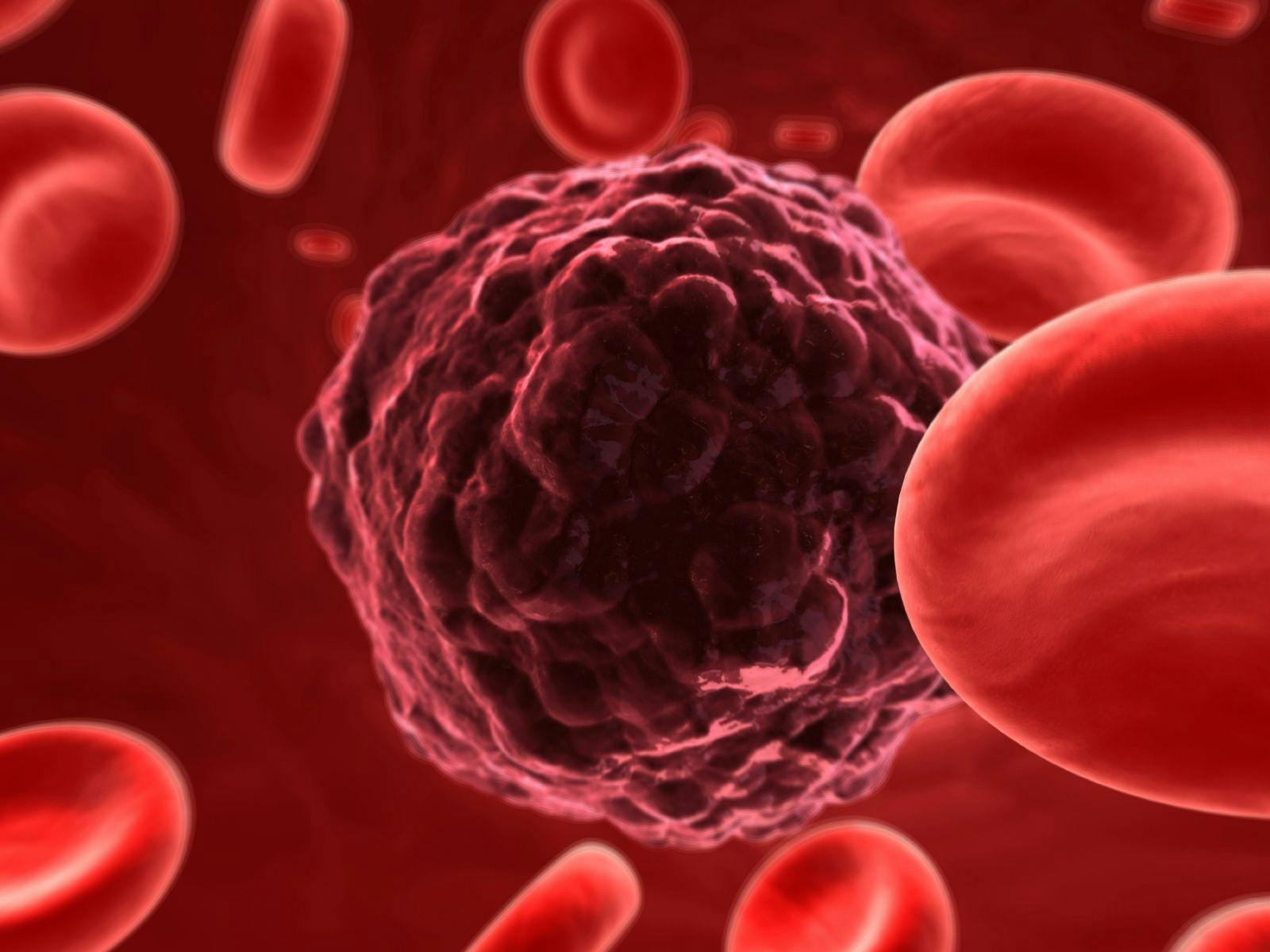 Giant Acute Myeloid Leukemia Data Set Offers a Leap Forward in Matching Therapies to Patients