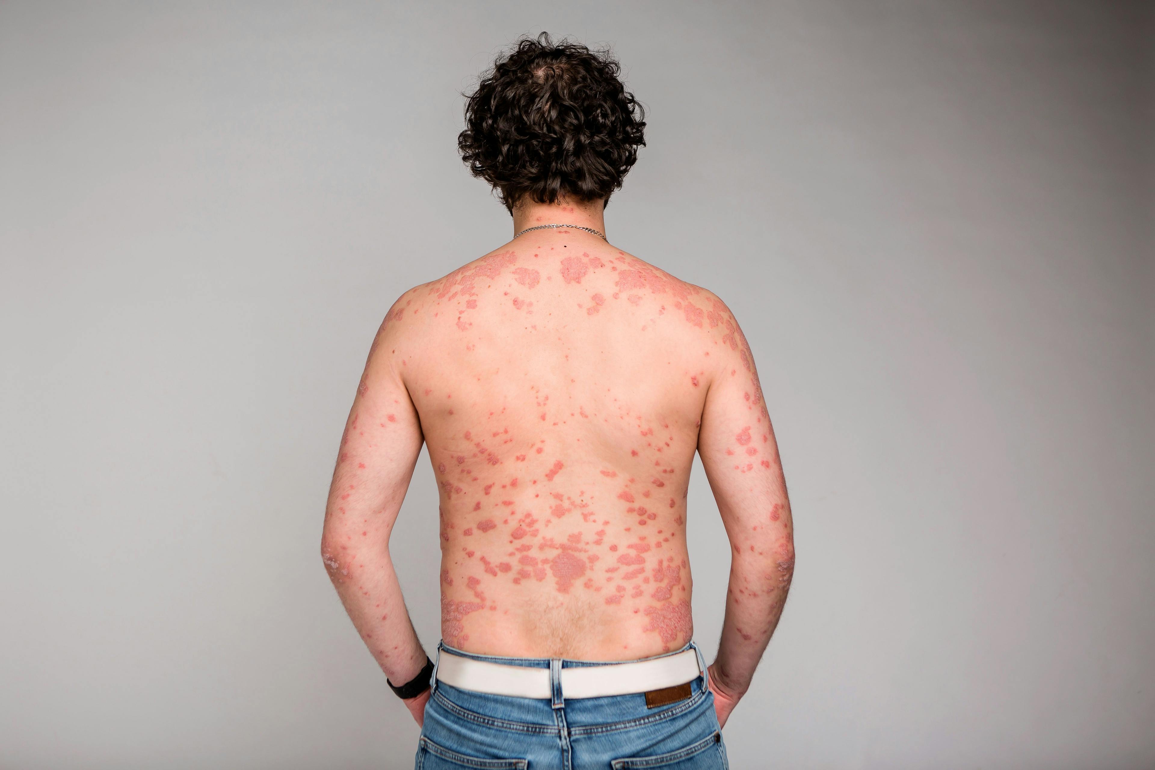 Psoriasis skin. Psoriasis is an autoimmune disease that affects the skin cause skin inflammation red and scaly | КРИСТИНА Игумнова - stock.adobe.com