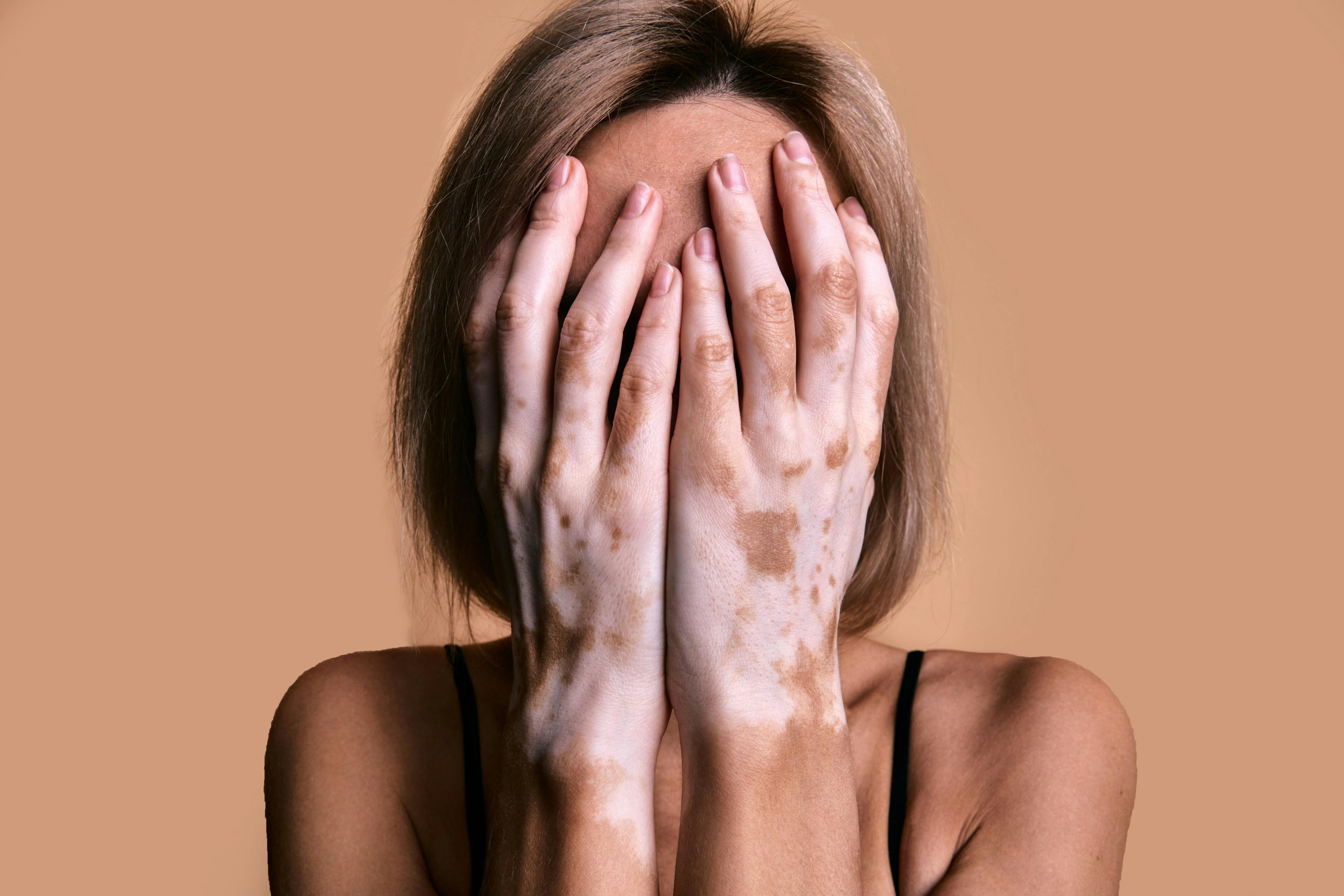 patient with vitiligo covering her face with her hands | Image Credit: Savory - stock.adobe.com