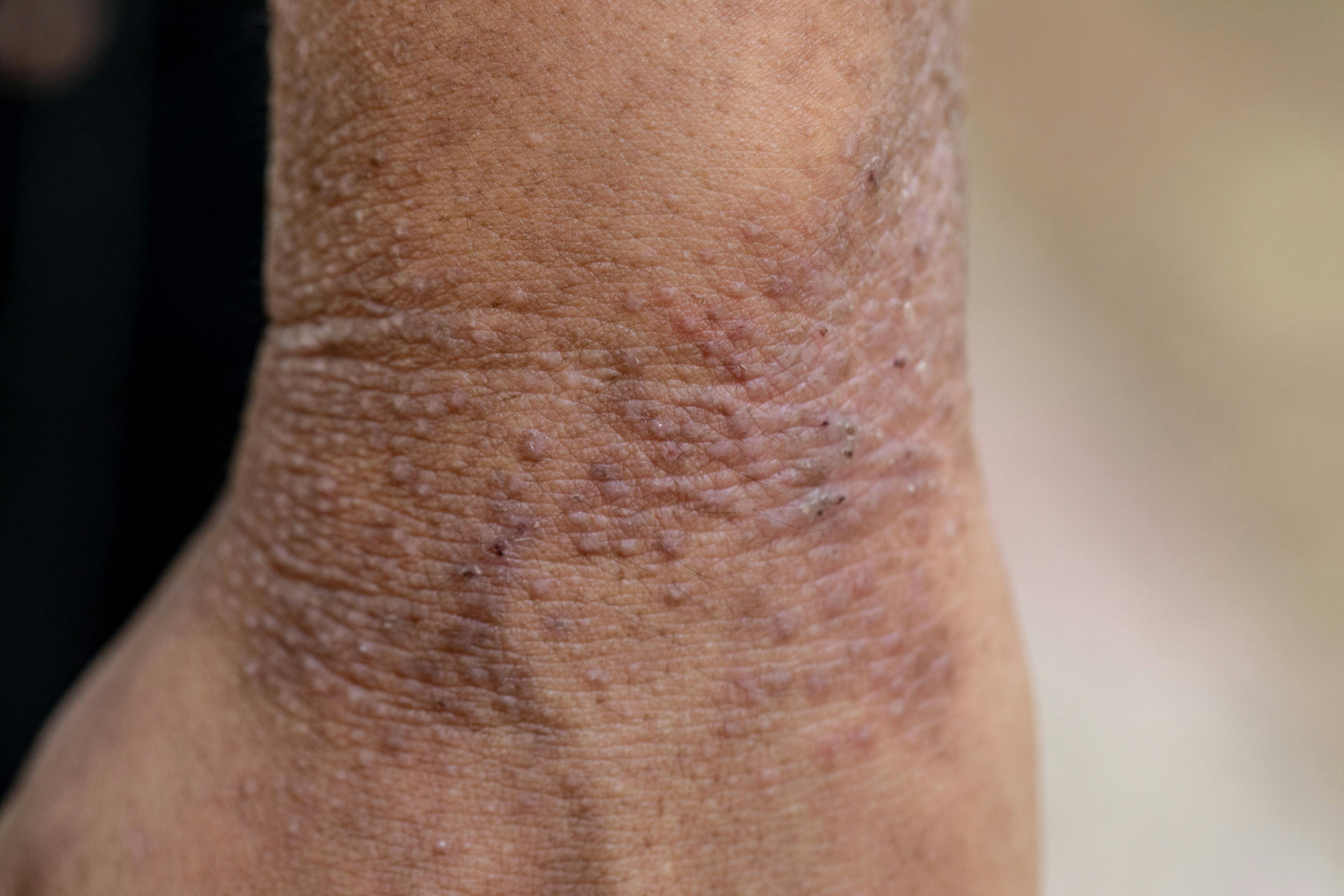 Atopic dermatitis | Image credit: sinhyu - stock.adobe.com