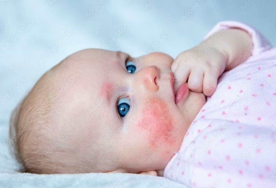 Image of a baby with eczema:  © AnastazjaSoroka - stock.adobe.com
