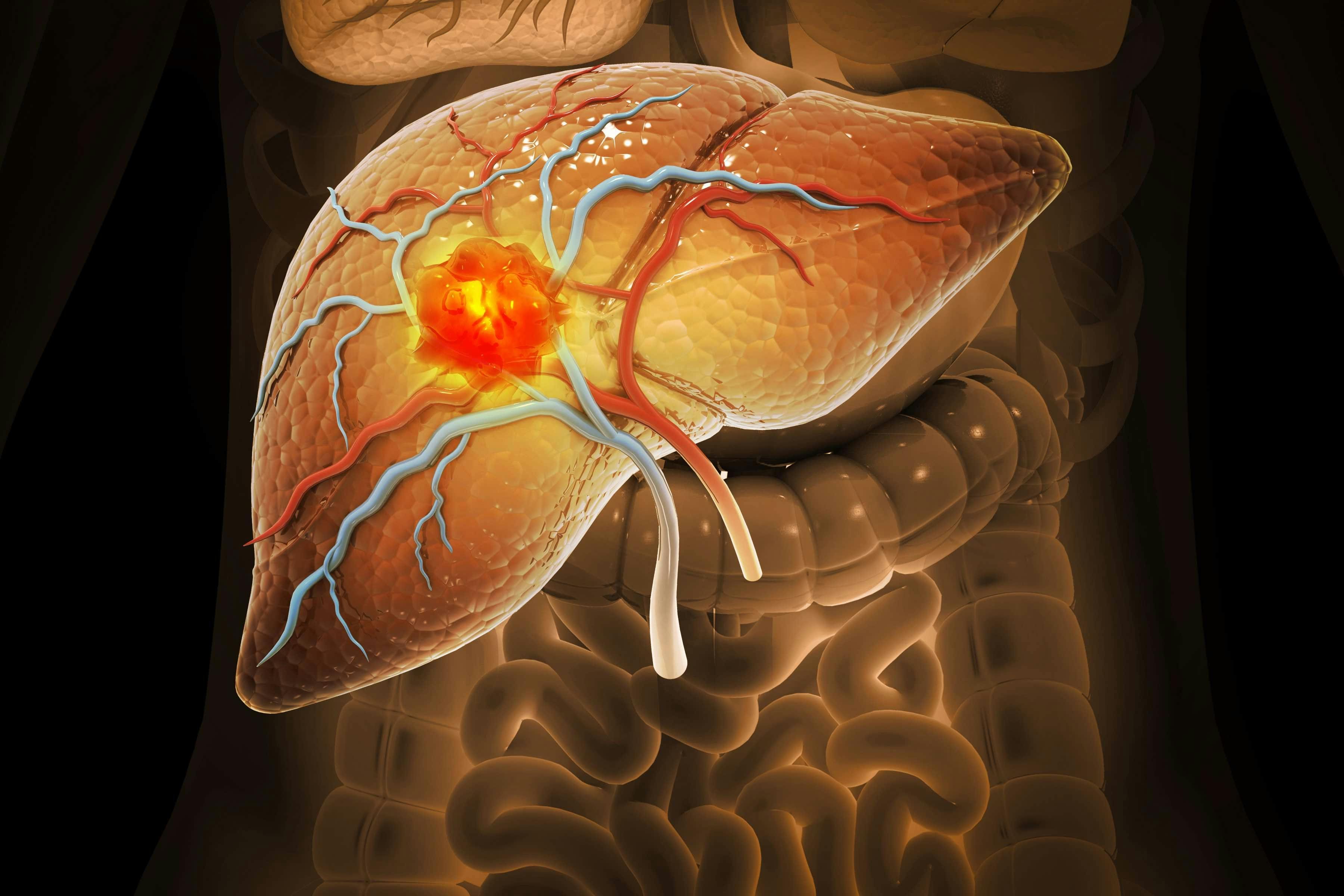 Illustration of hepatocellular carcinoma - Crystal light - stock.adobe.com