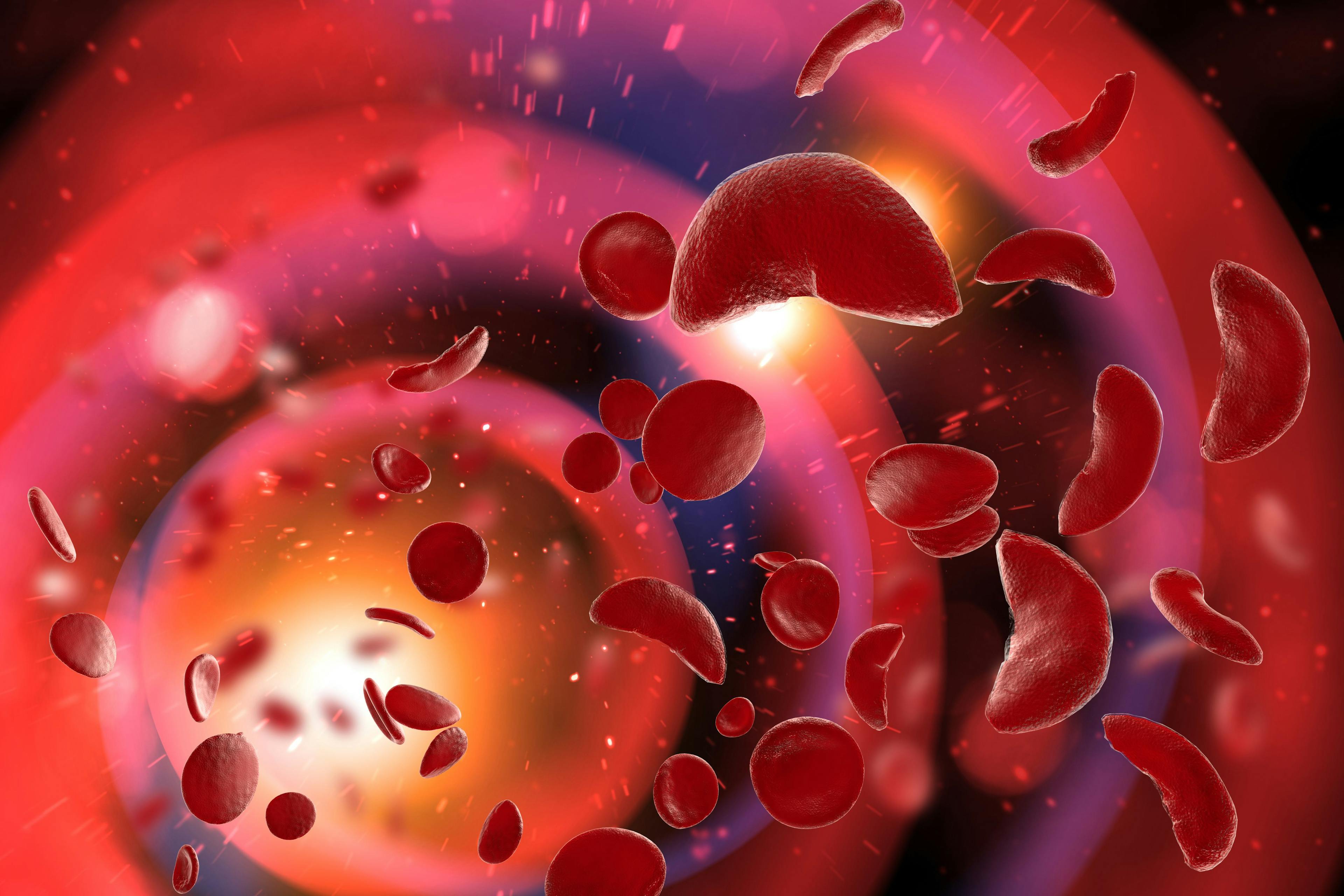 Sickle Cell Anemia 3D Illustration | Image Credit: © Ezume Images - stock.adobe.com
