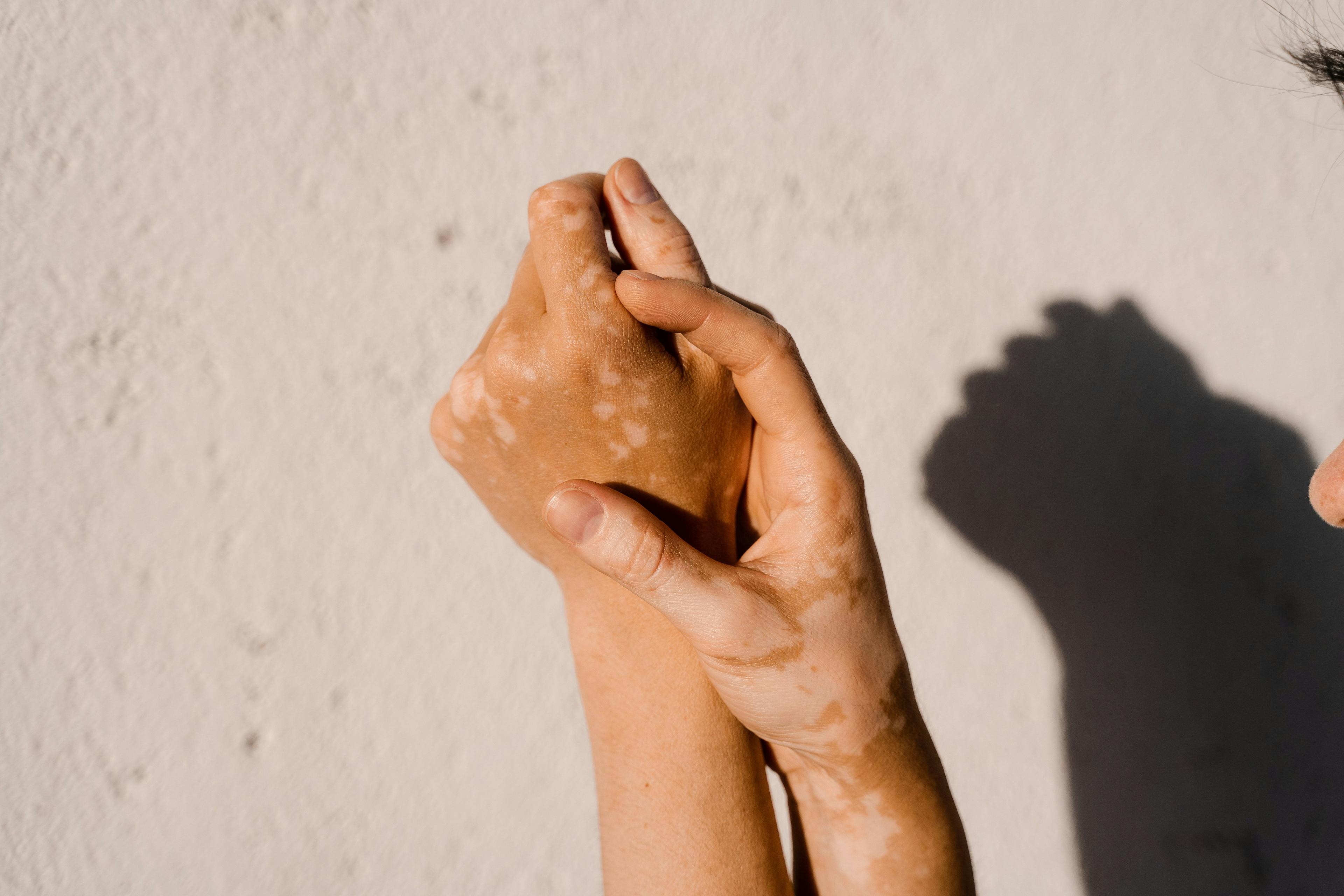 Vitiligo skin pigmentation on the hands of woman | Image Credit: Rabizo Anatolii - stock.adobe.com
