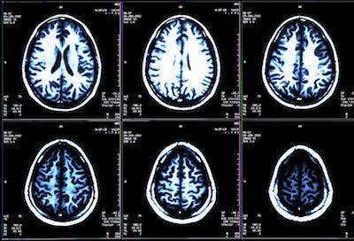 Neurofilament Light Prevalence Predicts Disease Progression in RRMS