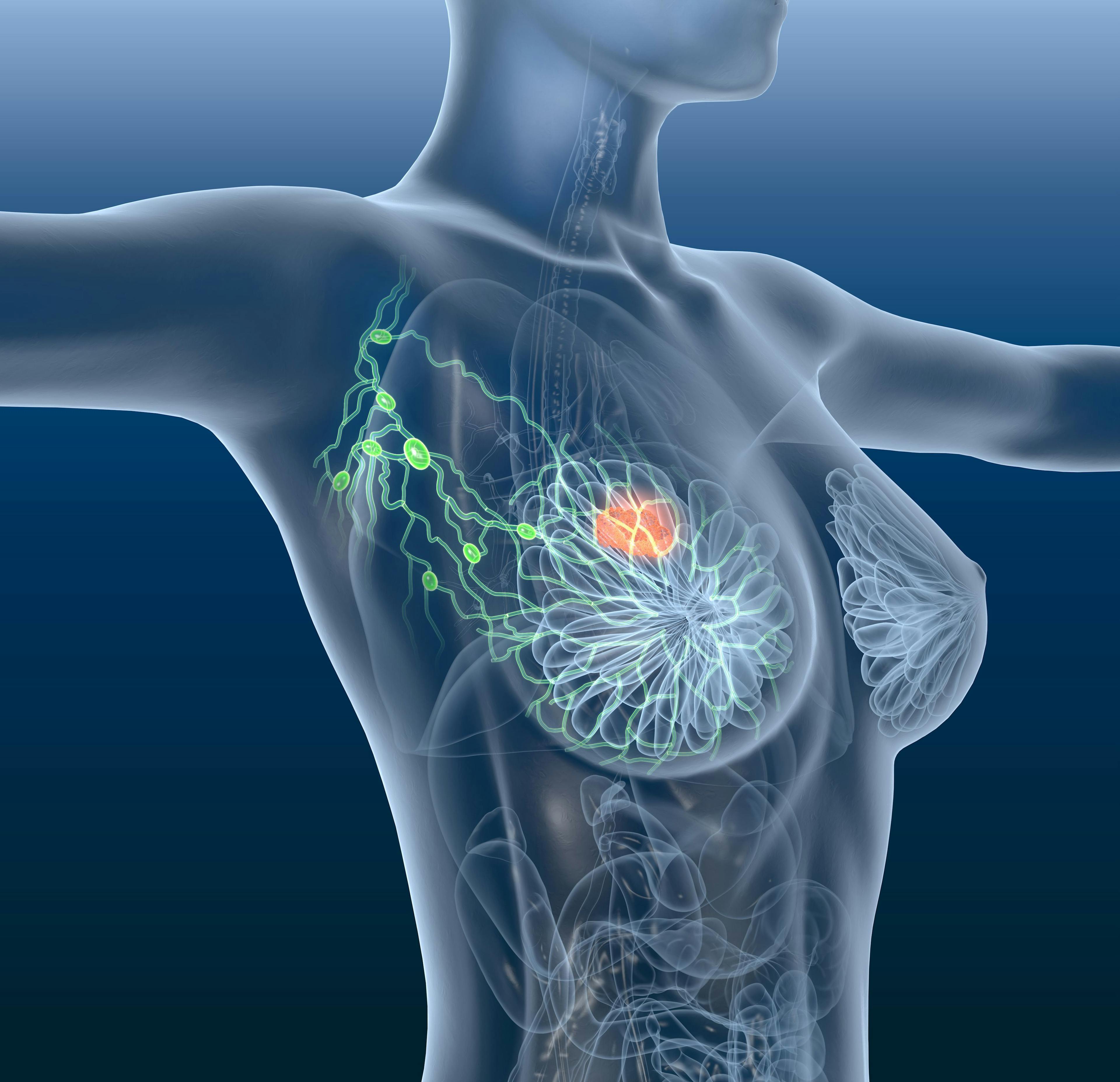 image of breast cancer