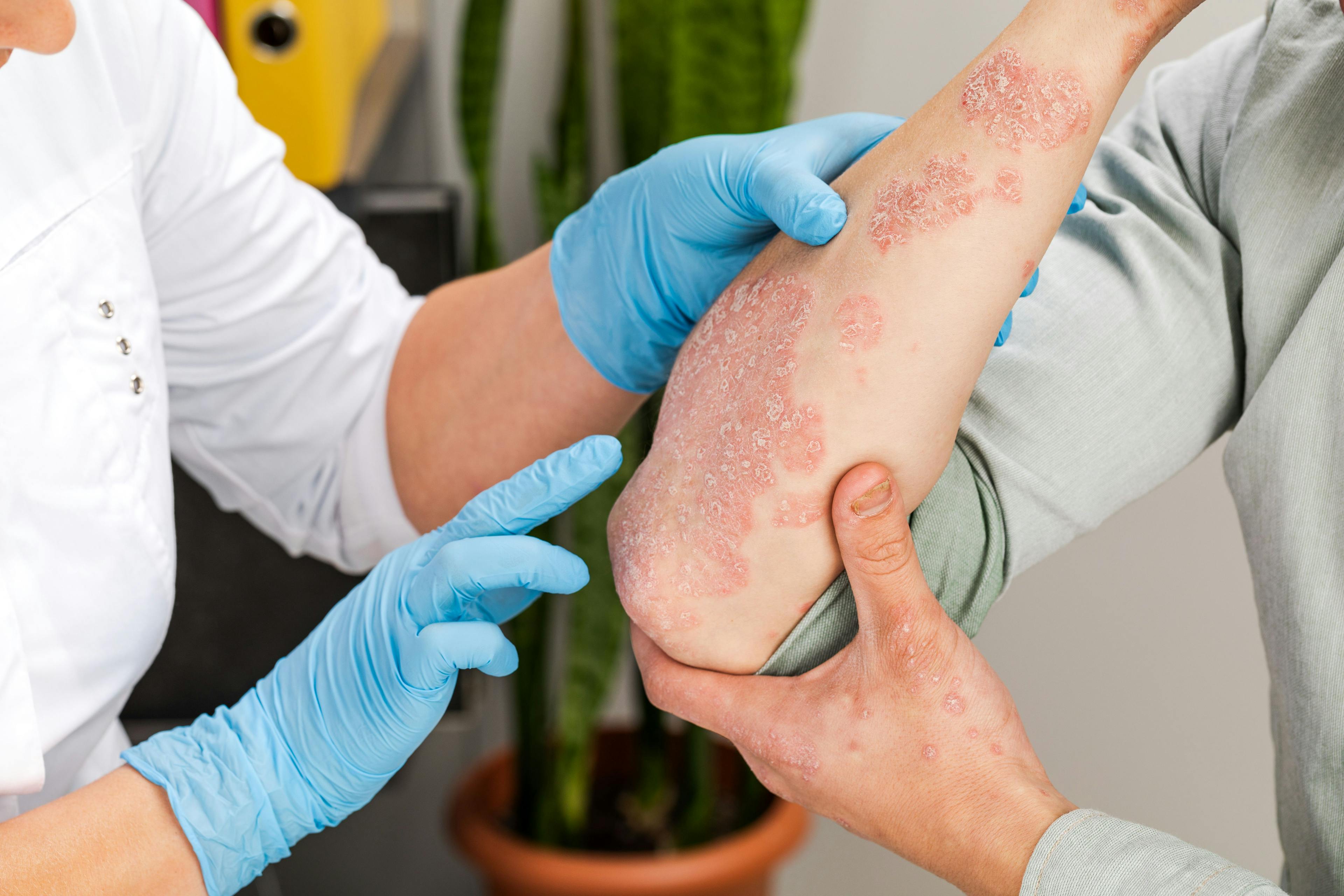 A dermatologist wearing gloves examines the skin of a sick patient. Examination and diagnosis of skin diseases-allergies, psoriasis, eczema, dermatitis | Image credit: fusssergei - stock.adobe.com