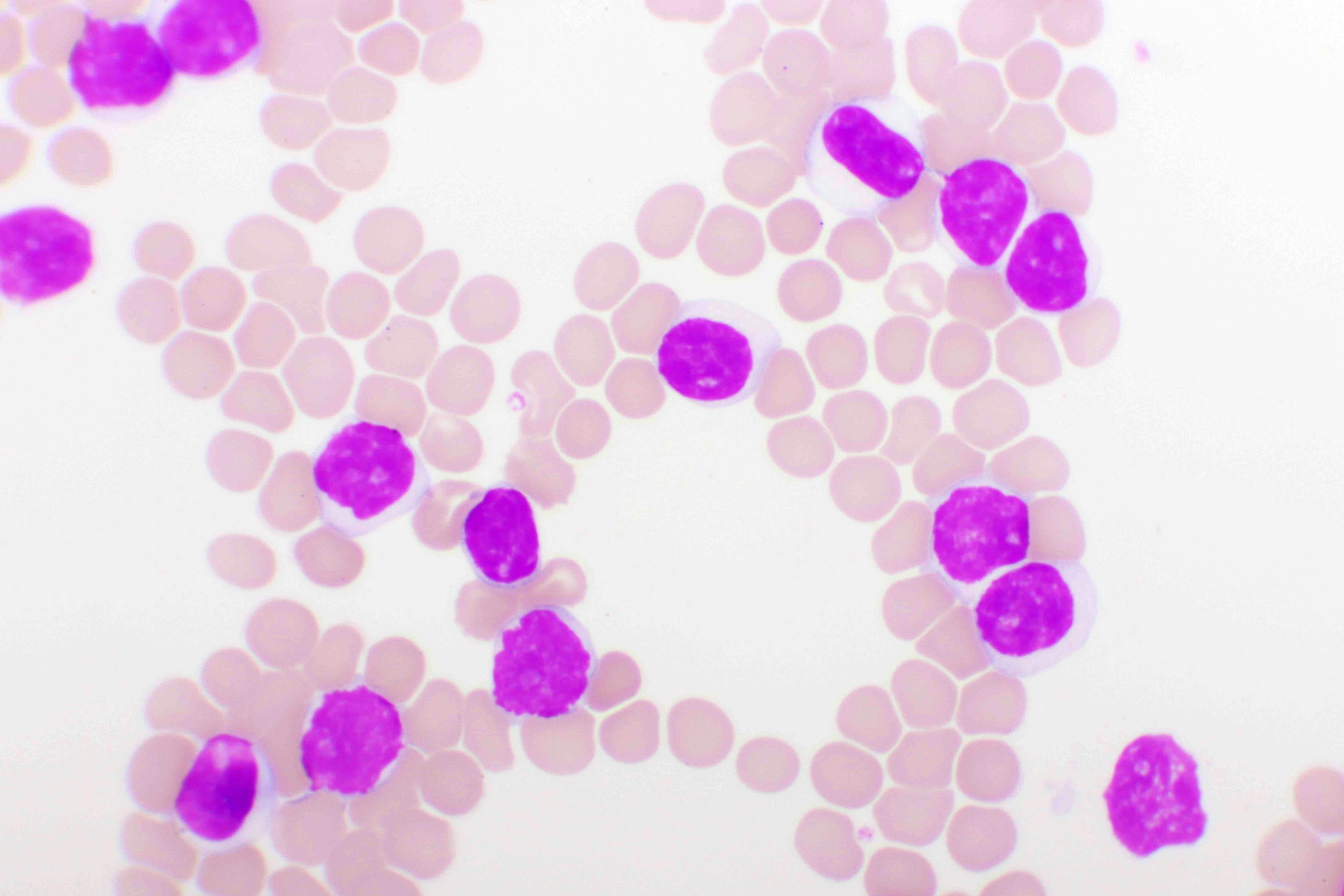 Chronic lymphocytic leukemia | Image credit: jarun011 - stock.adobe.com