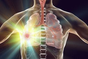 AI Beats Radiologists in Detecting Lung Cancer, Study Finds