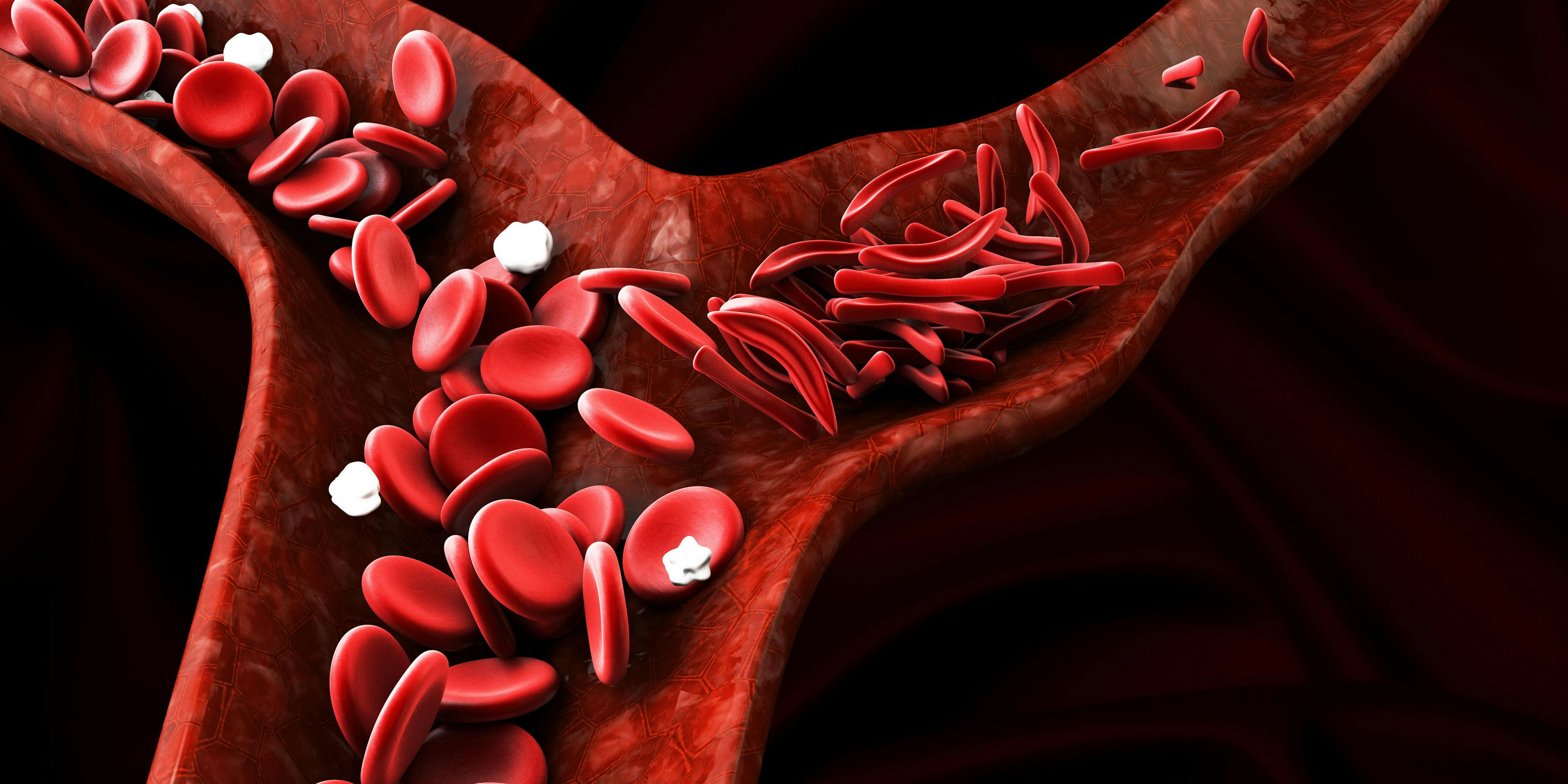 Sickle cell anemia, showing blood vessel with normal and deformated crescent | Image credit: tussik - stock.adobe.com