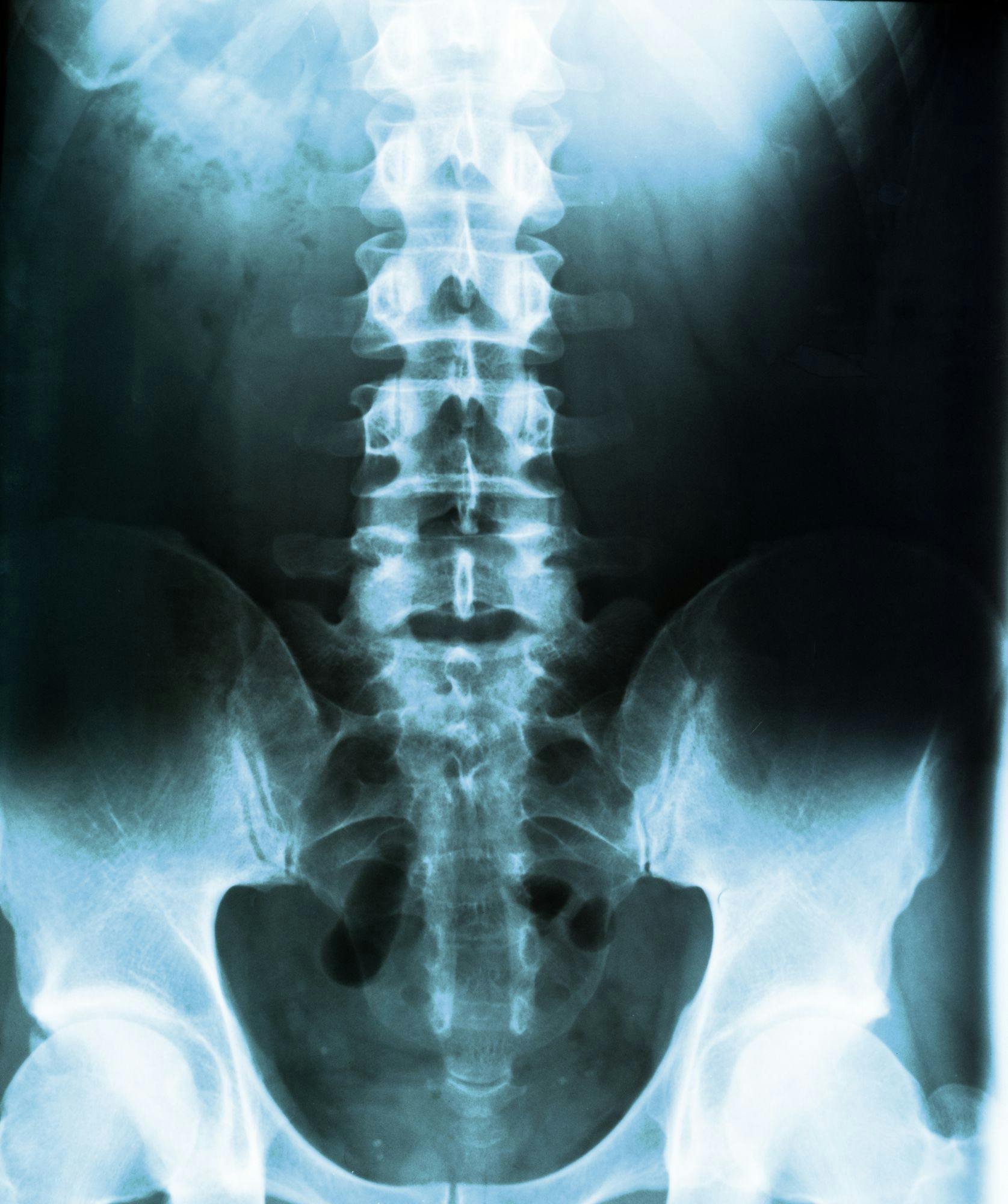 Image of a spine x-ray
