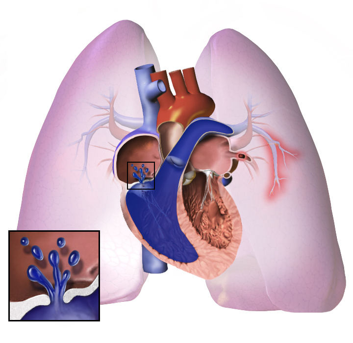 pulmonary abnormality