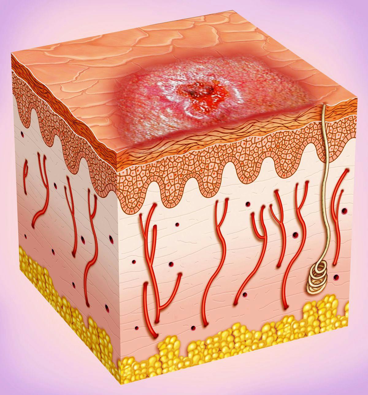 Image of basal cell carcinoma