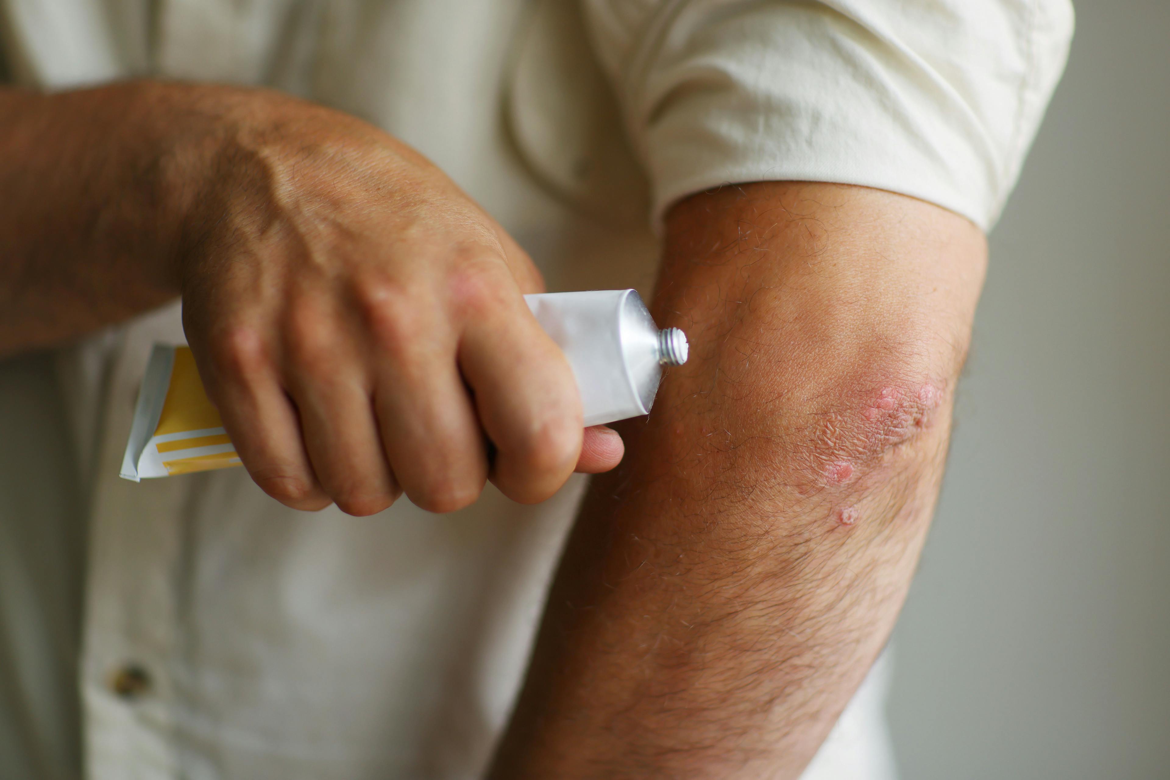 A man applies topical cream to plaque psoriasis patch on arm |  Olga - stock.adobe.com