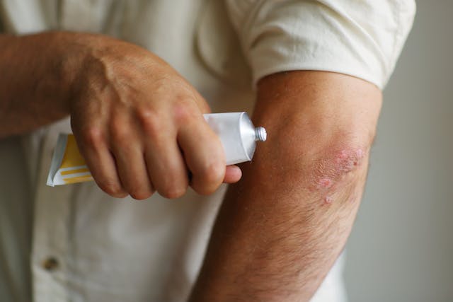 A man applies topical cream to plaque psoriasis patch on arm | Image Credit: © Olga - stock.adobe.com