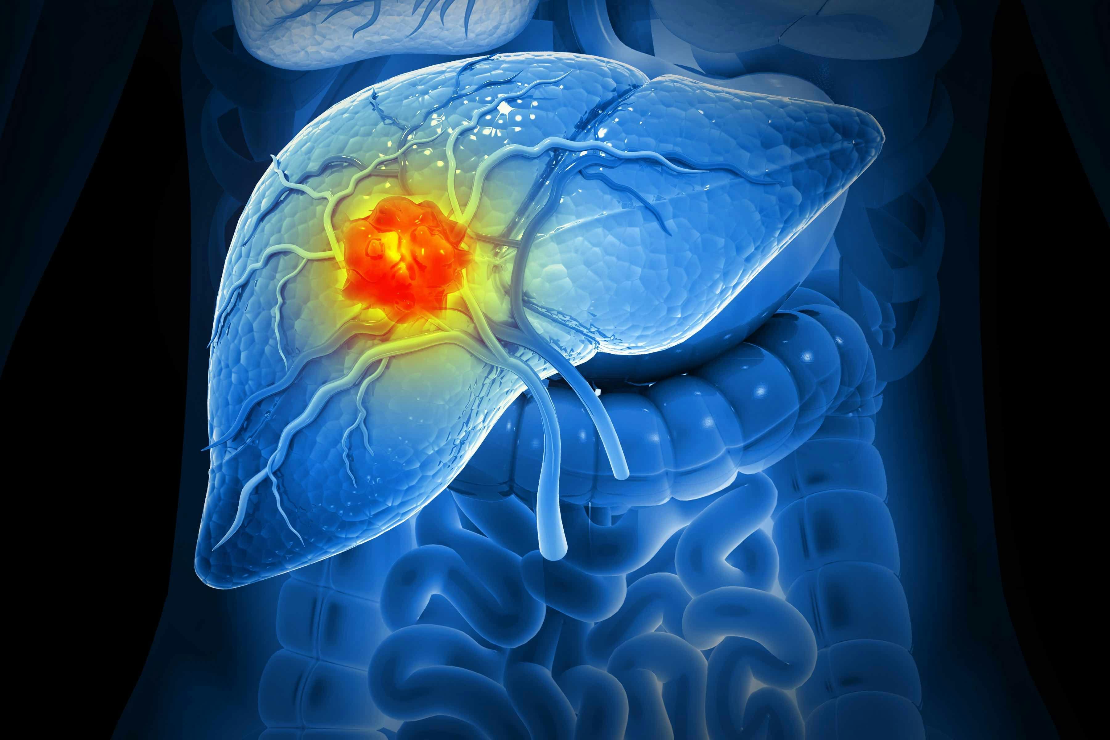 Hepatocellular carcinoma illustration | Image credit: Crystal light - stock.adobe.com