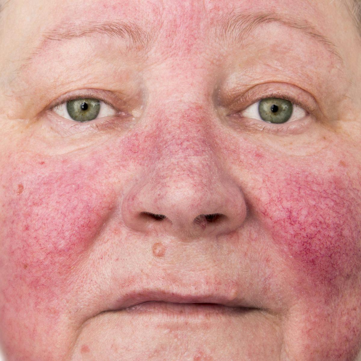 image of rosacea