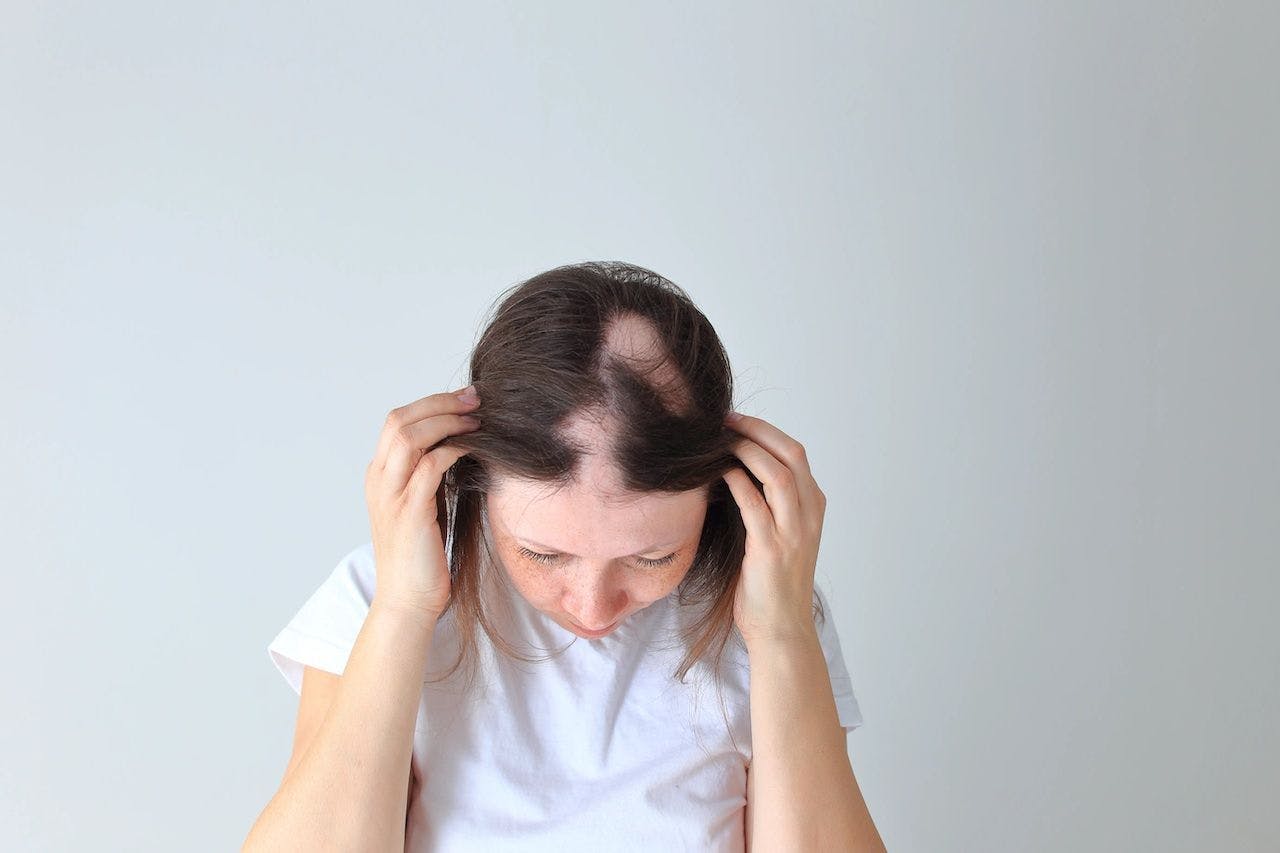 Alopecia areata in a young girl.

Image credit: Nadya Kolobova - stock.adobe.com