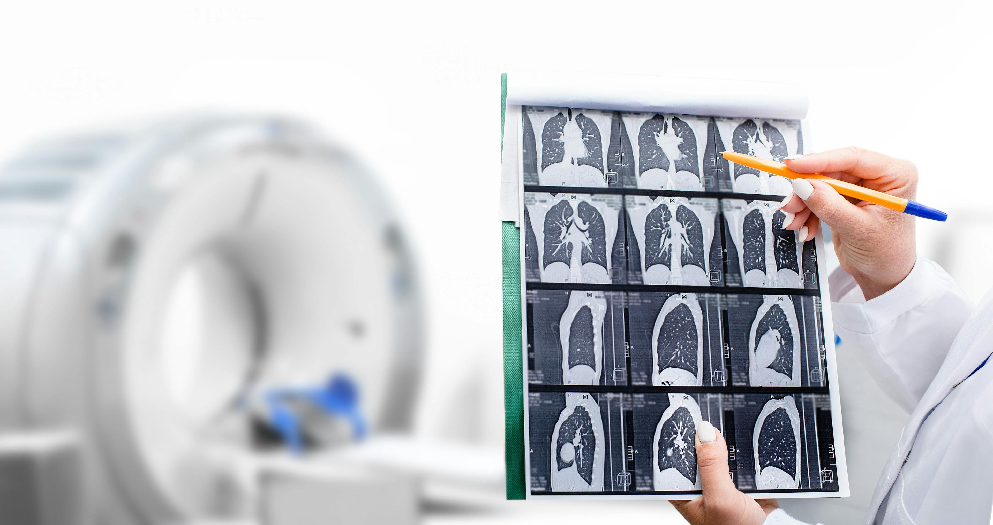 Radiologist showing tomography scan of a patient's lungs over of CT machine. Treatment of lung diseases, pneumonia, coronavirus, covid, cancer, tuberculosis | Image credit: © Peakstock - stock.adobe.com.