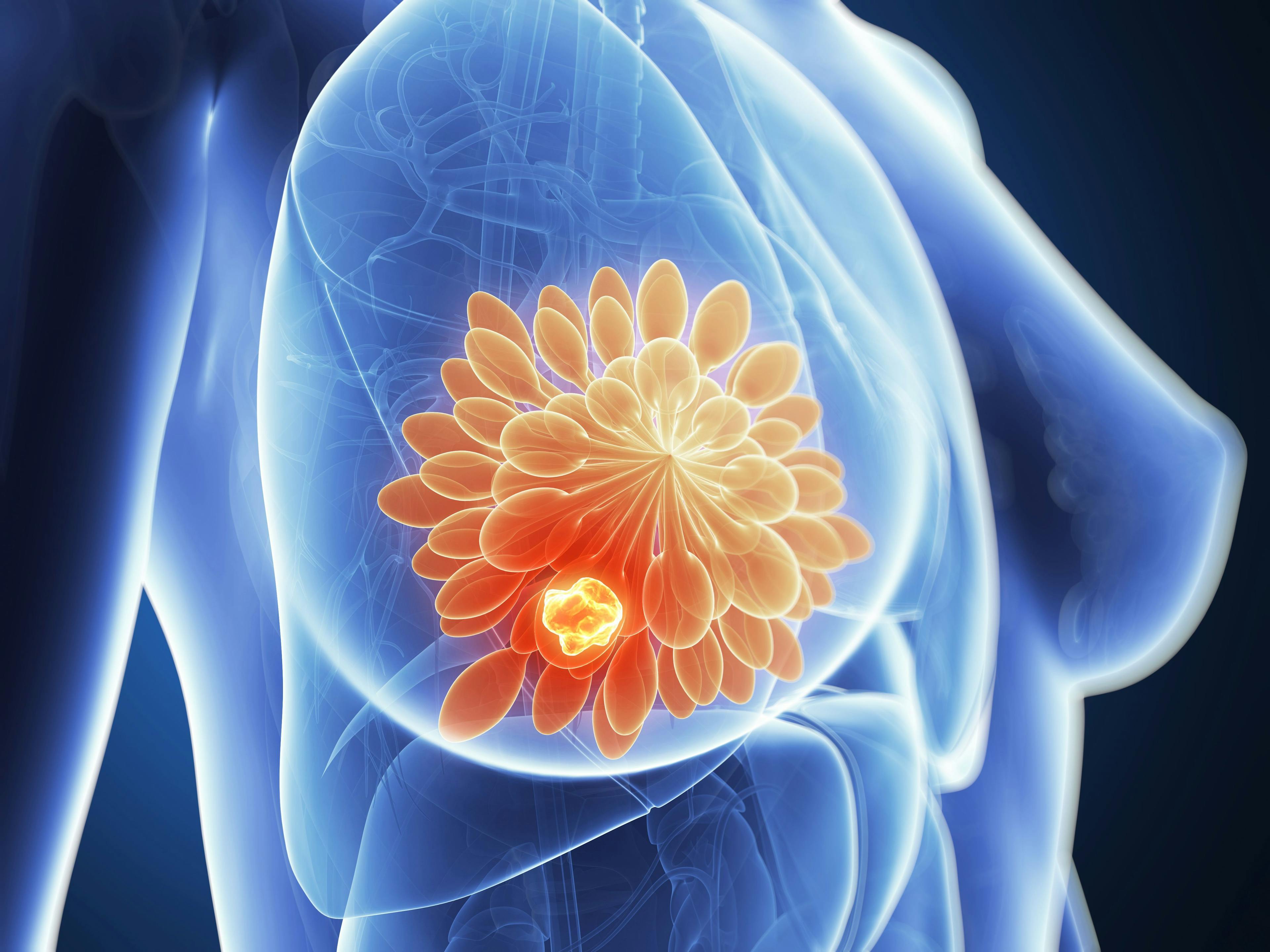 3-D illustration of breast cancer | Image credit: SciePro - stock.adobe.com