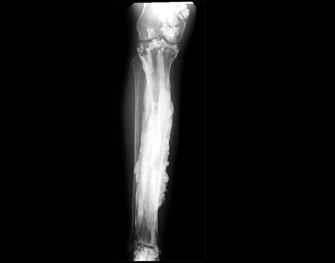 Discovery About Rare Bone Disease May Also Hold Clues About Bone Health