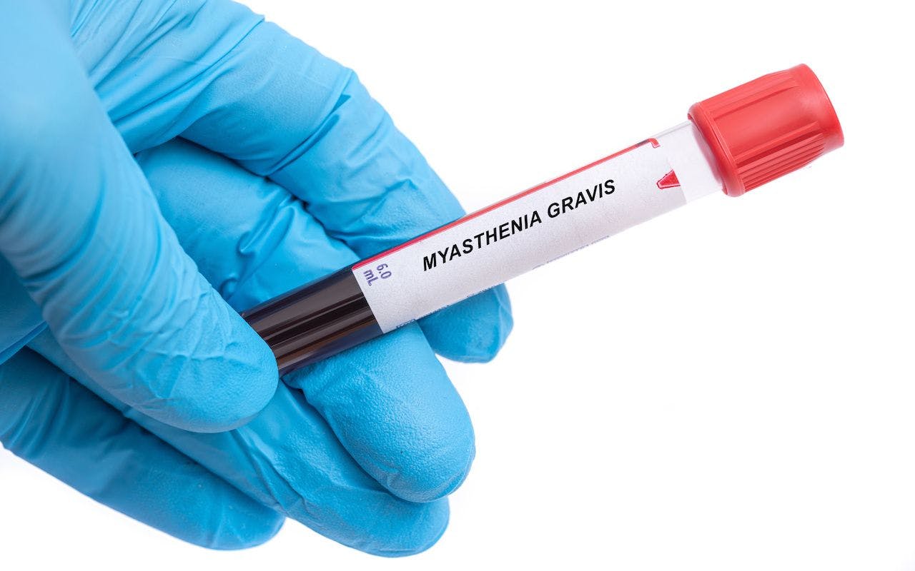 Myasthenia Gravis. Myasthenia Gravis disease blood test in doctor hand: © luchschenF - stock.adobe.com