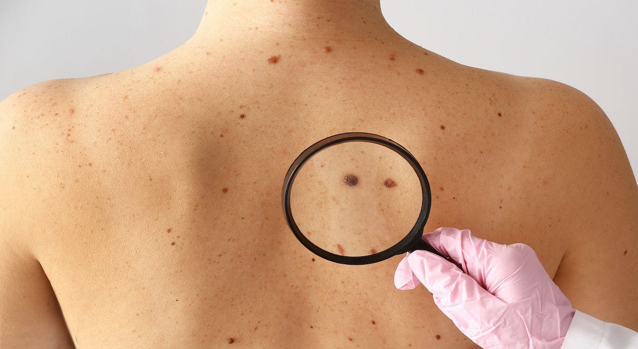 Dermatologist examining moles of patient in clinic: © Pixel-Shot - stock.adobe.com