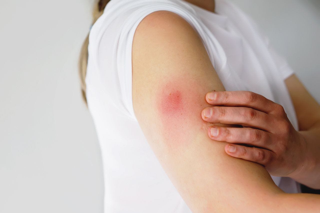 Vaccination reaction on arm of woman after injection of covid corona virus vaccine. Swollen part, red puncture site. Unrecognizable person: © Irina Schmidt - stock.adobe.com
