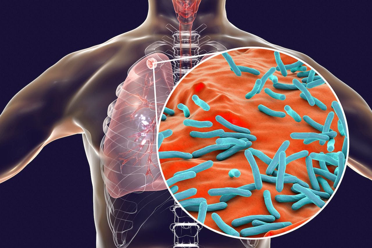 Secondary tuberculosis in lungs and close-up view of Mycobacterium tuberculosis bacteria, 3D illustration: © Dr_Microbe - stock.adobe.com