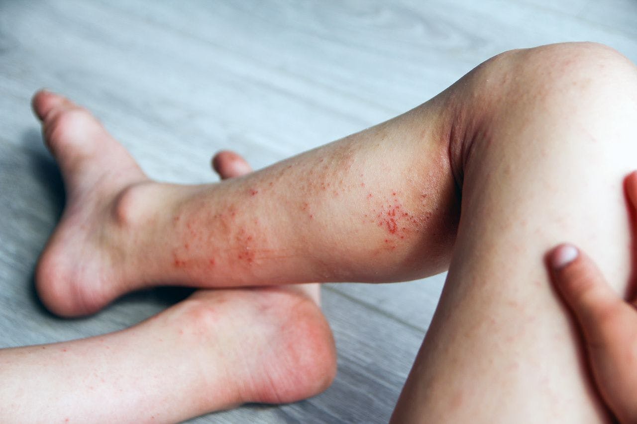 Atopic dermatitis on the legs of a child: © Kostia - stock.adobe.com