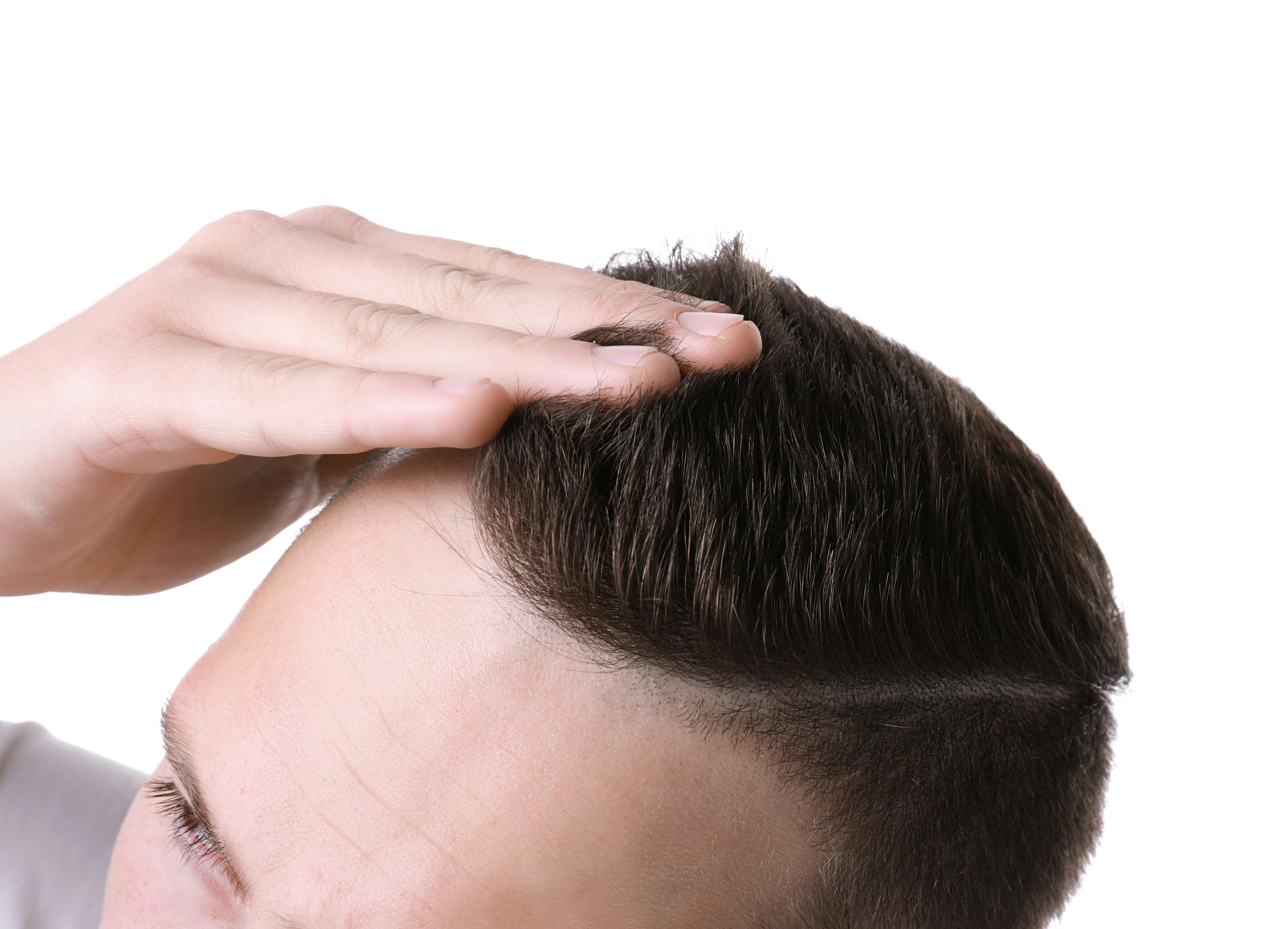 Man with hair loss measuring regrowth | Image Credit: Pixel-Shot - stock.adobe.com