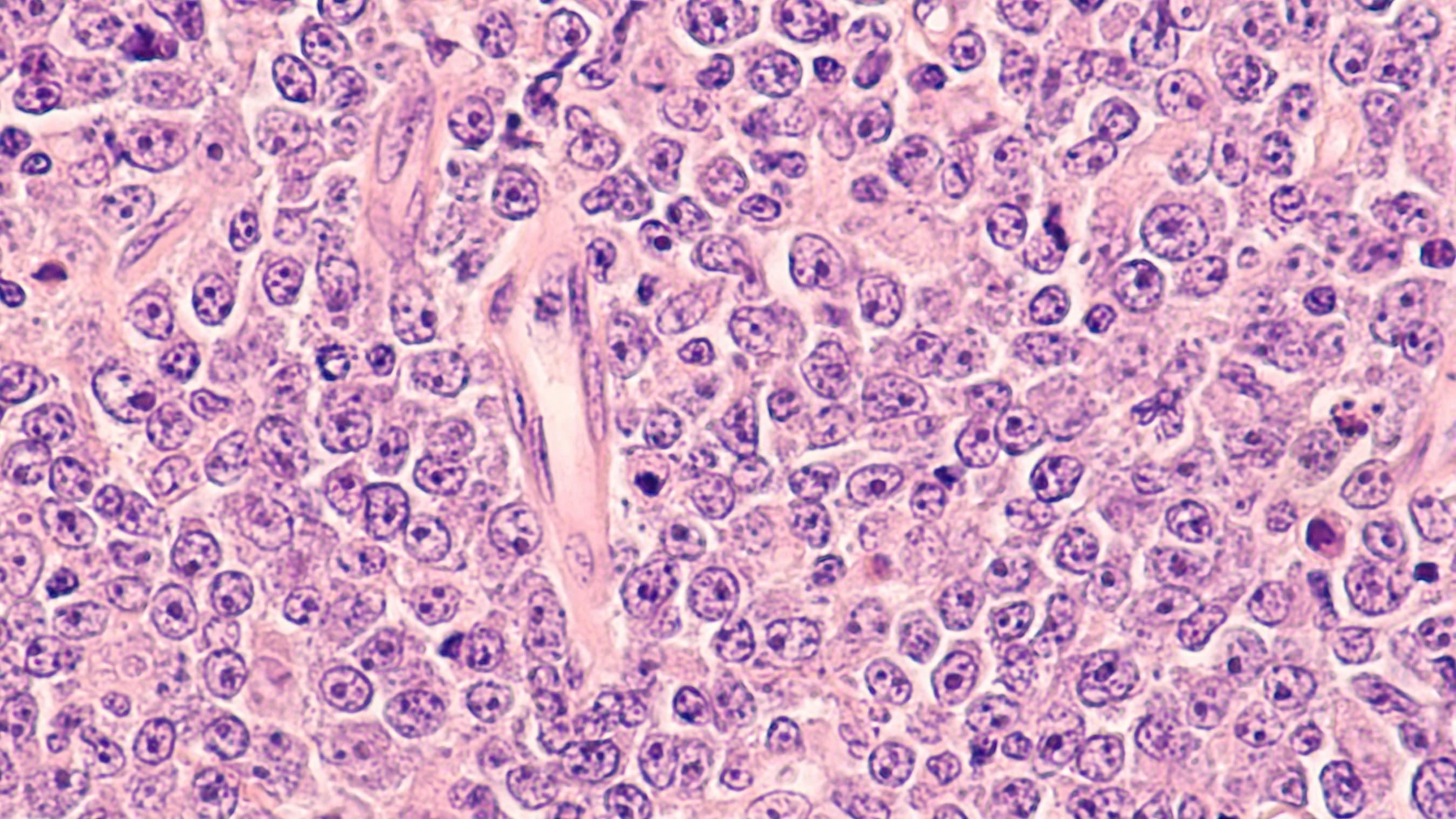 Diffuse large B-cell lymphoma - David A Litman - stock.adobe.com