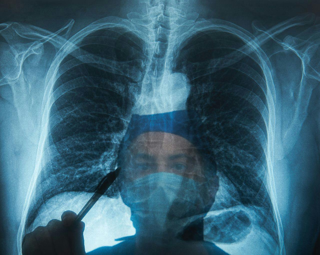 Patients With COPD Given Bronchoscopic Lung Reduction Have Longer Median Survival 