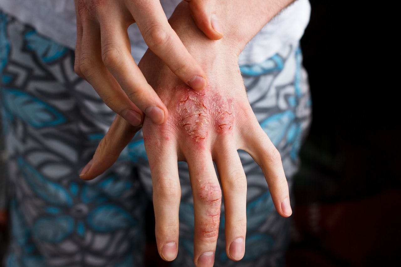 Researchers Examine Short-term, Long-term Efficacy of Biologics, Oral Agents for Plaque Psoriasis