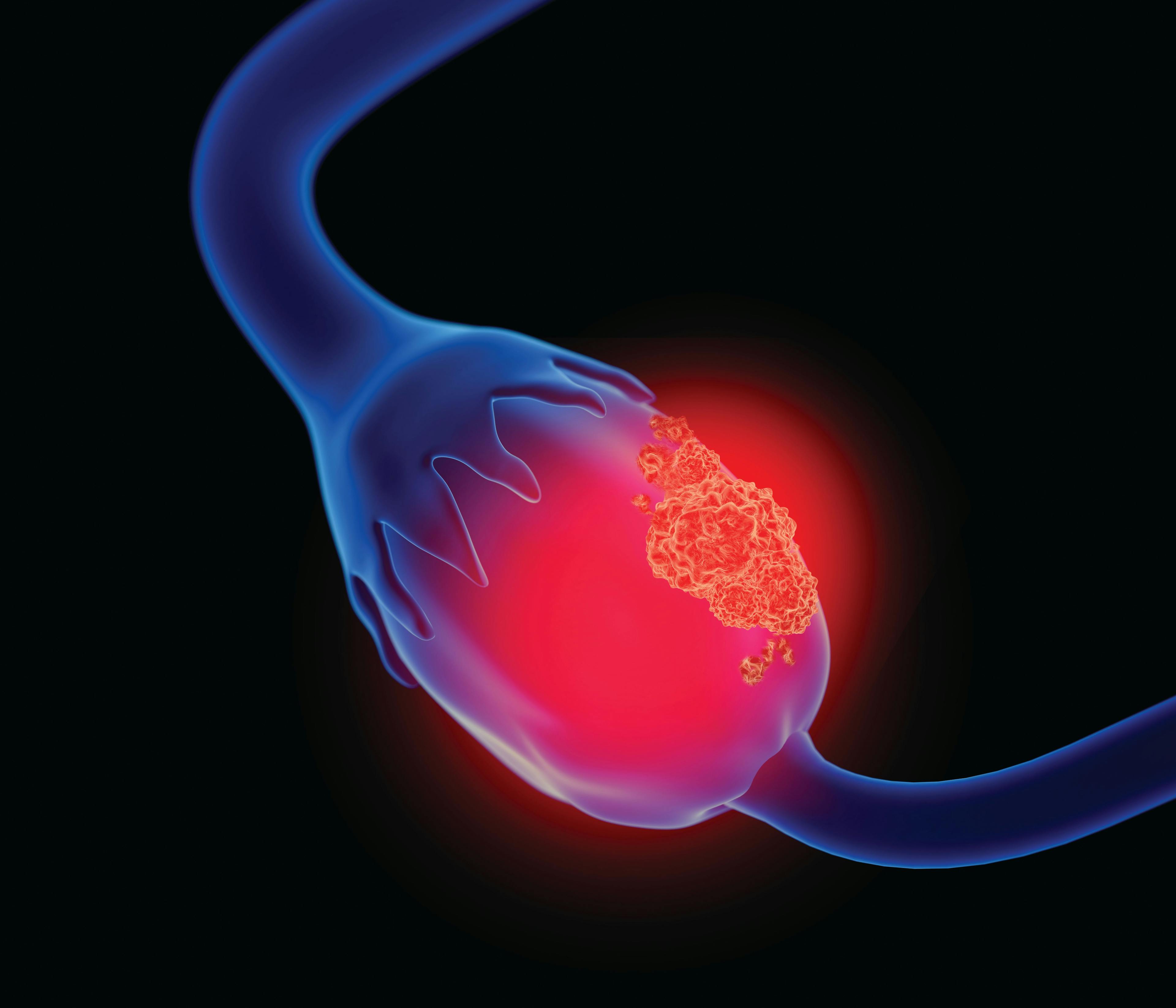 Ovarian tumor graphic
