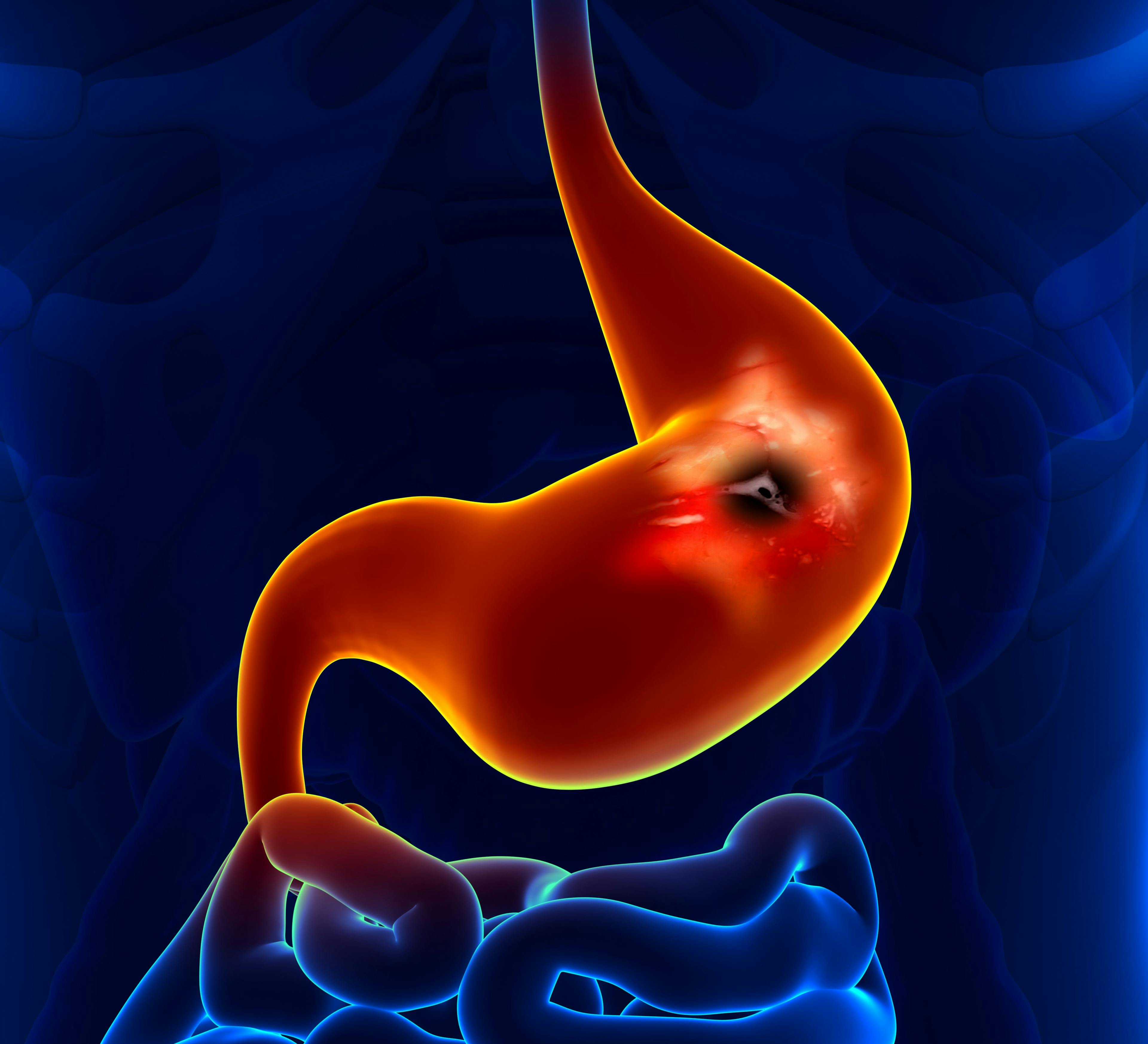 Nivolumab approved by FDA when combined with certain chemotherapies for gastric cancers