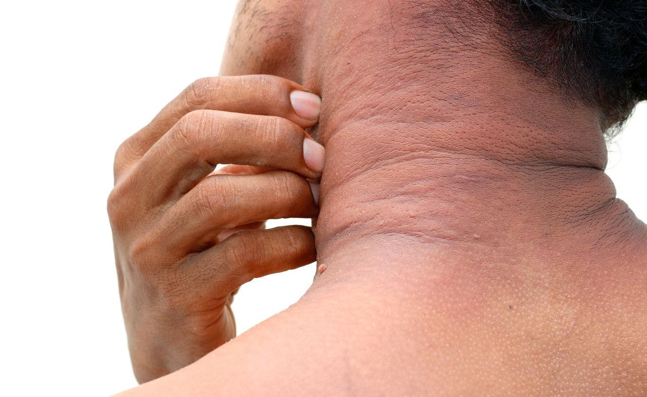 Man with neck eczema