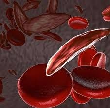 sickle cell / NIH