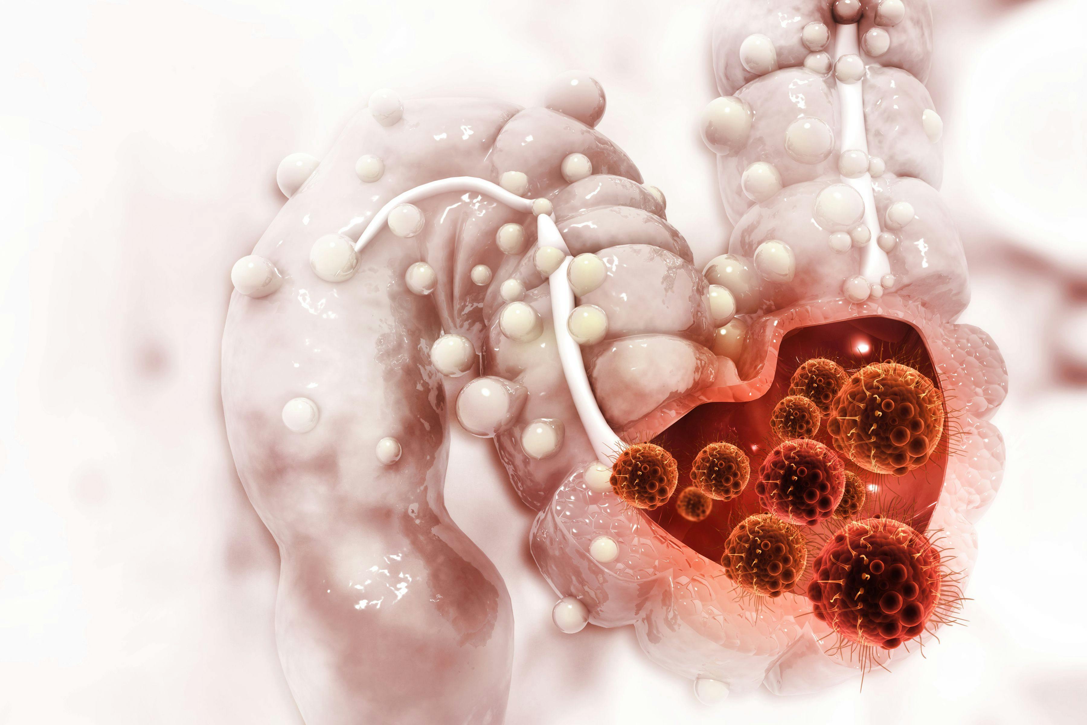 Cancer cells in colon | Image credit: Crystal light - stock.adobe.com