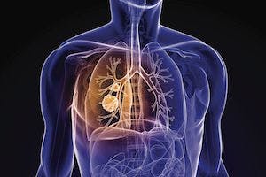 Risk-Targeted Lung Cancer Screening Shows Modest Benefits 