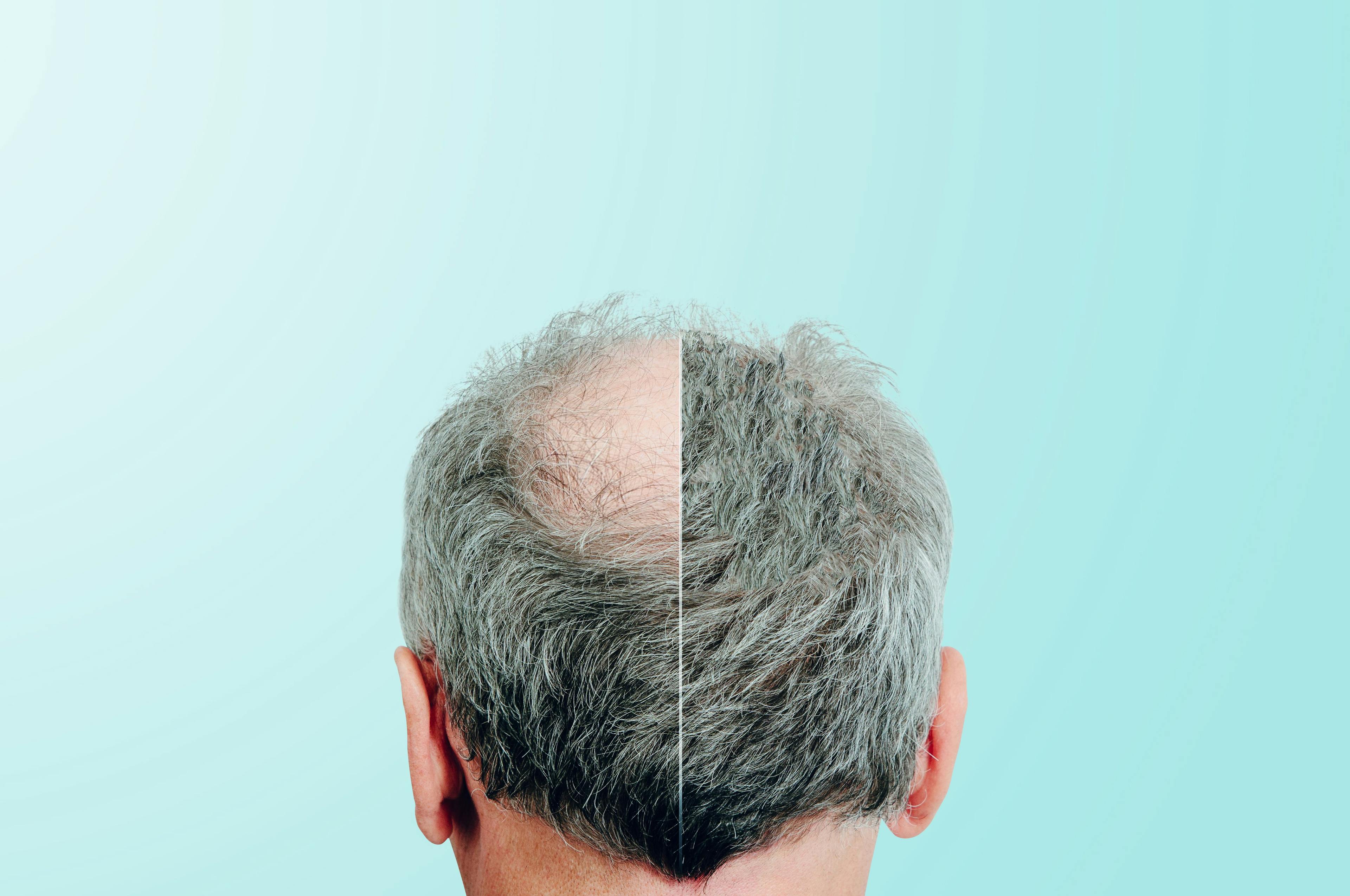 Before and after hair regrowth, rear view of male head | Image Credit: Sebastian - stock.adobe.com