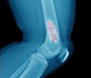 Providing Pain Relief for Patients With Bone Metastases