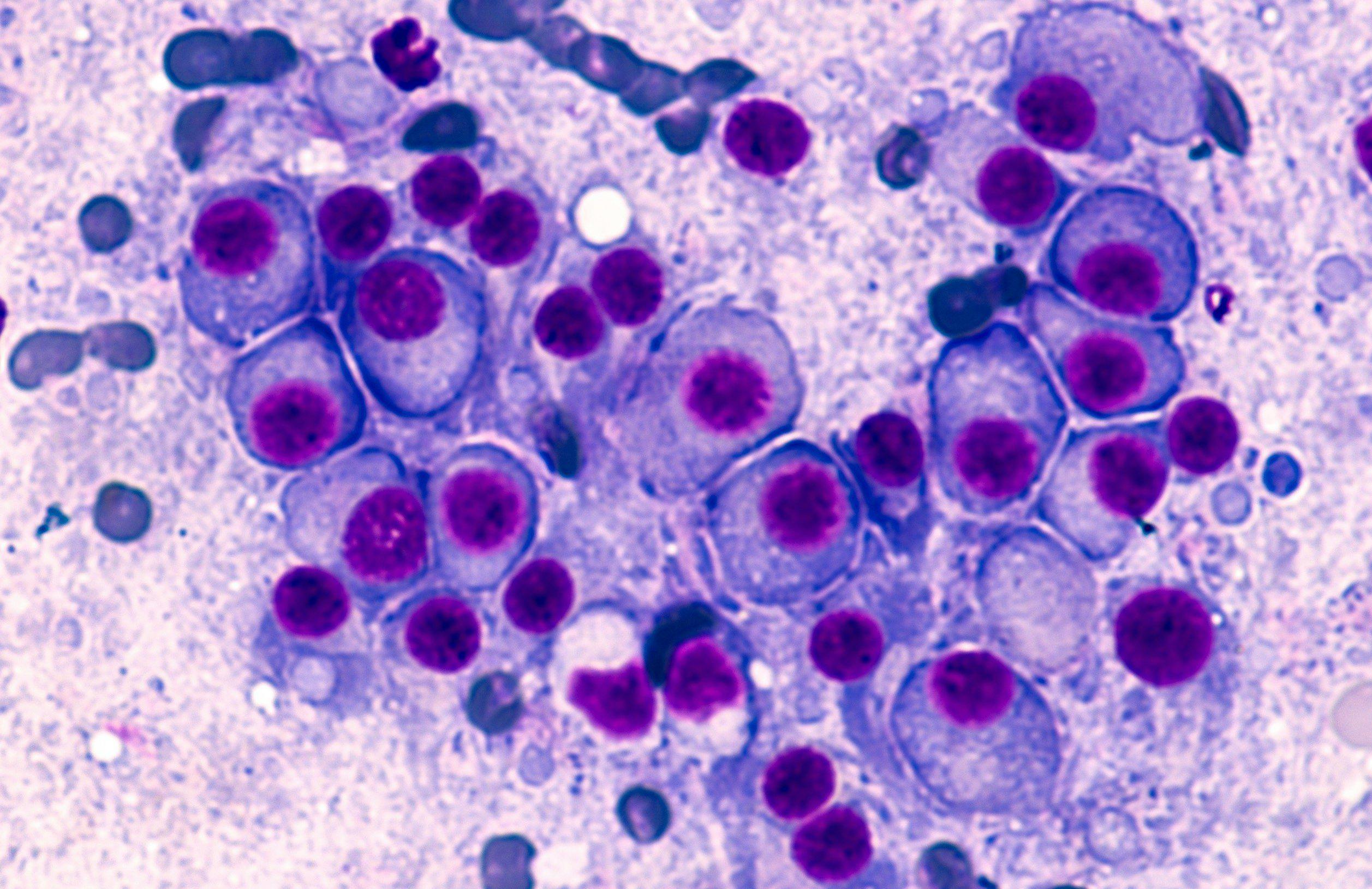 Multiple myeloma cells | Image credit: David A Litman - stock.adobe.com