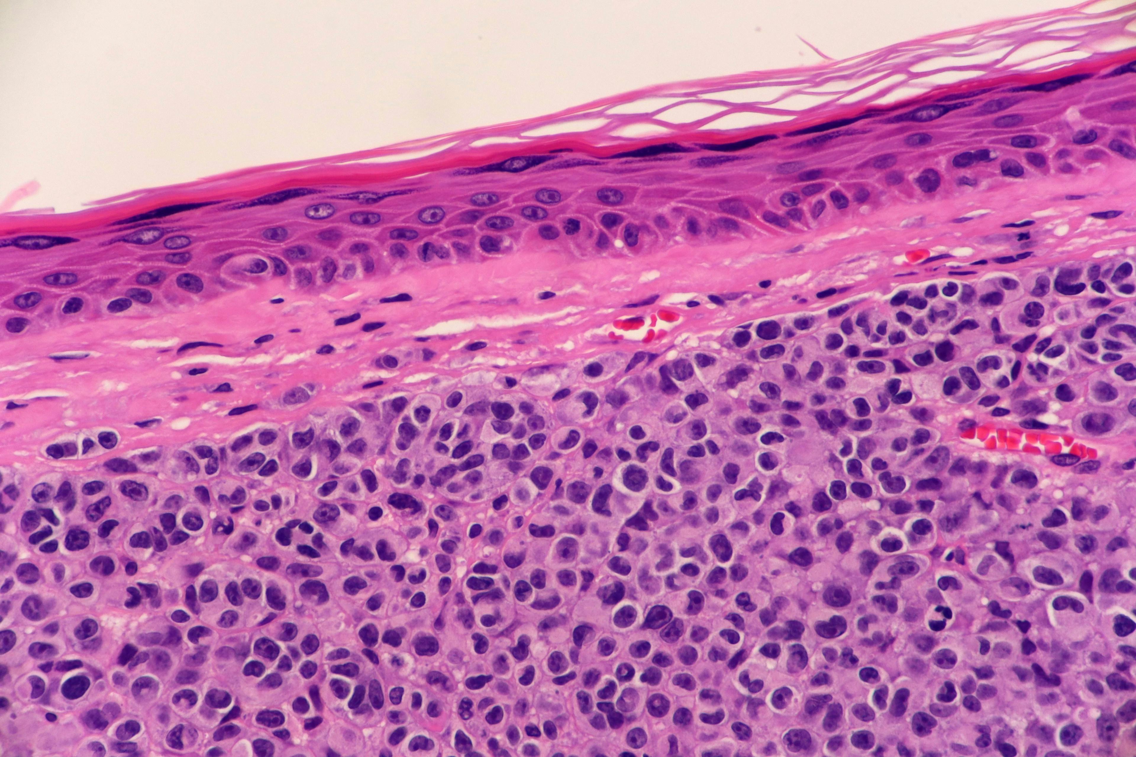 Microscopic View of Nodular Melanoma | image credit: Lisa - stock.adobe.com